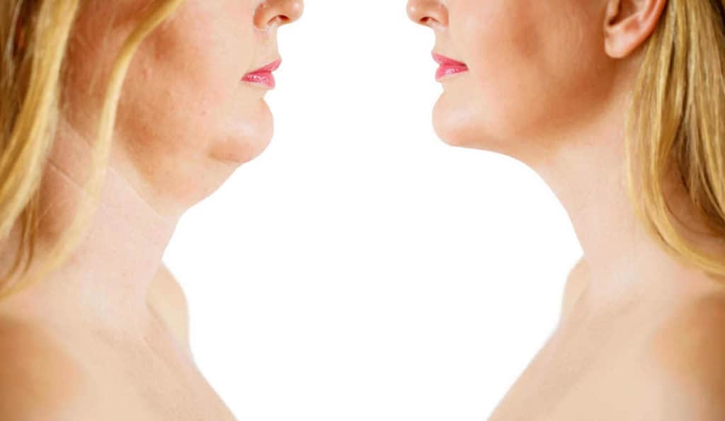 Double Chin treatment Wentworth before and after results