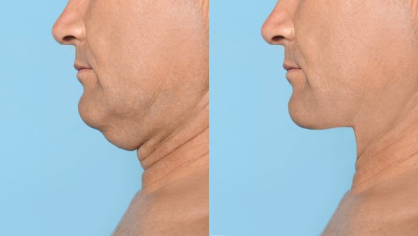 Which Non-Surgical Treatments Work Best for Jowls and Loose Skin Wentworth?