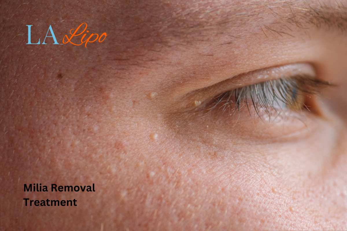 Cryopen Milia Removal: Is It the Easiest and Safest Option Wentworth?