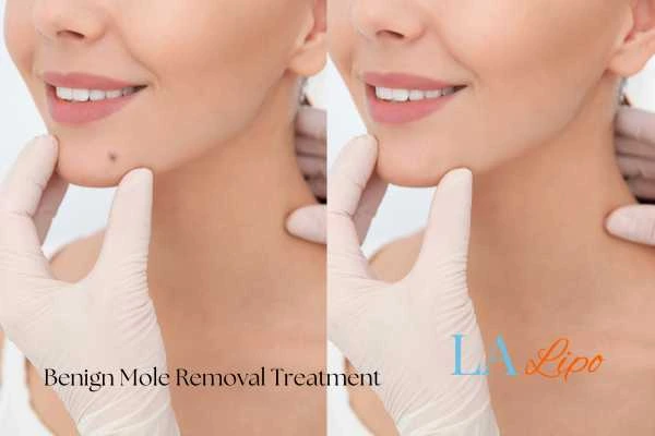 Before-and-after results following benign mole-removal treatment Wentworth