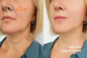 hi-fu for wrinkles Wentworth before and after results