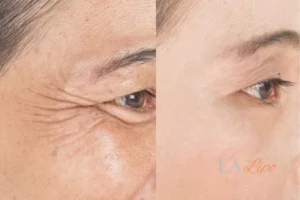 Before and after results of woman - HI-fu wrinkles reduction treatment Wentworth