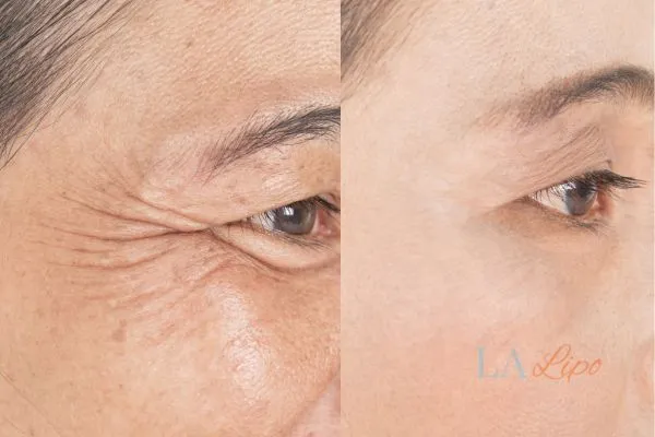 Before and after results of woman - HI-fu wrinkles reduction treatment Wentworth