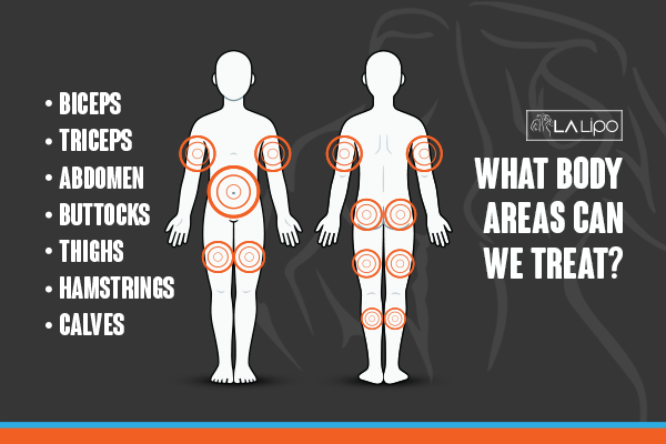 Graphic to show areas you can have LA-EMS Body Sculpting Wentworth treatment.