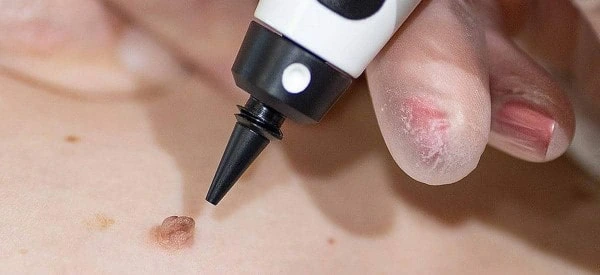 skin tag removal using cryopen Wentworth