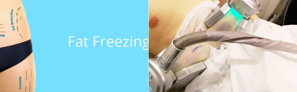 Fat freezing Wentworth on multiple areas of the body