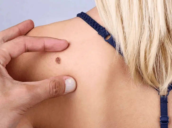 woman having mole removal Wentworth consultation before treatment.