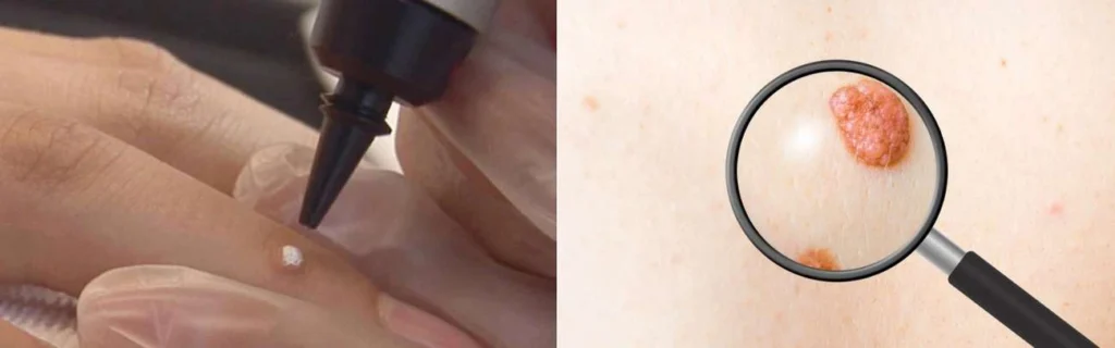 CryoPen practitioner Wentworth assessing a benign mole before treatment