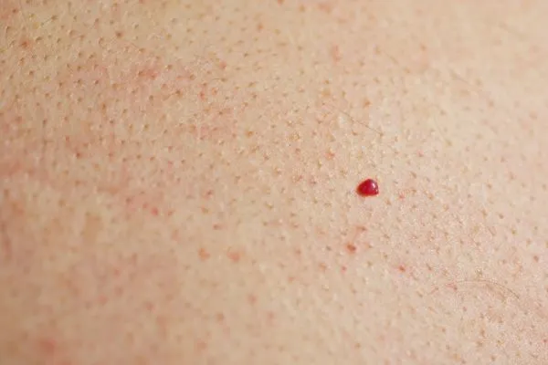 close up of a cherry angioma Wentworth
