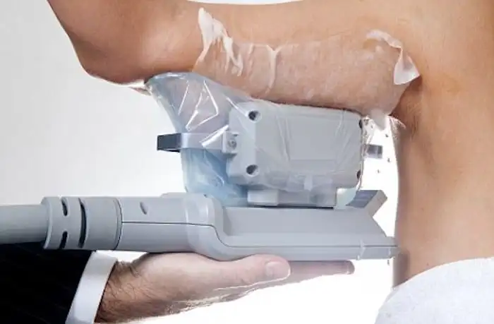 Picture of fat freezing Wentworth on the upper arms.