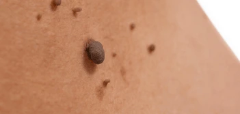 image of a skin tag Wentworth