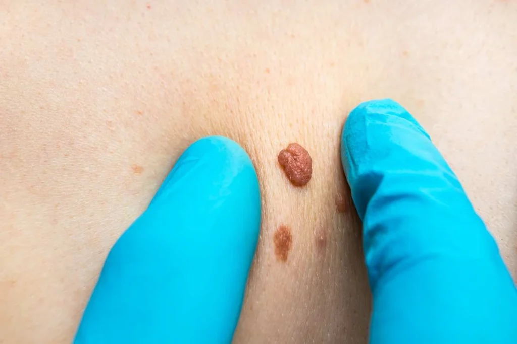 Consultant examining a skin tag Wentworth