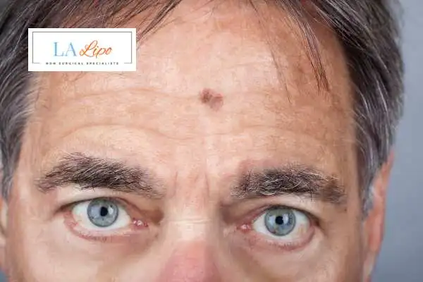Solar Lentigo Removal Wentworth image of man with mark on his forehead