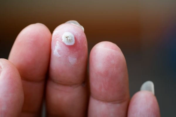 wart on person finger - cryotherapy to treat from LA LIPO Wentworth
