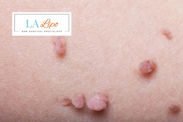 Does cryopen skin tag removal Wentworth hurt? Find out now call our team today!