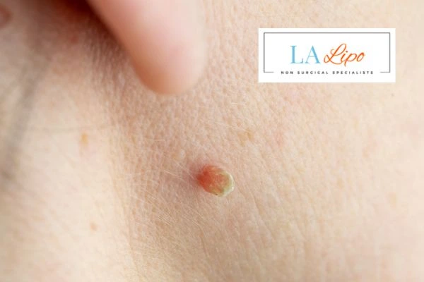 Book skin tag removal Wentworth today speak to our team now!
