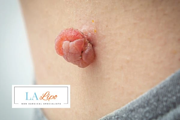Interested in skin tag removal Wentworth? Concerned about the pain? Find out more today!