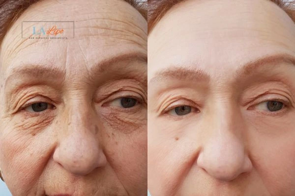 The powerful benefits of Morpheus8 Treatment Wentworth - Call Our team today!