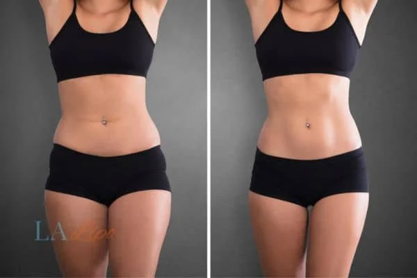 before and after results of non-surgical treatment to help a woman's body image and mental health Wentworth