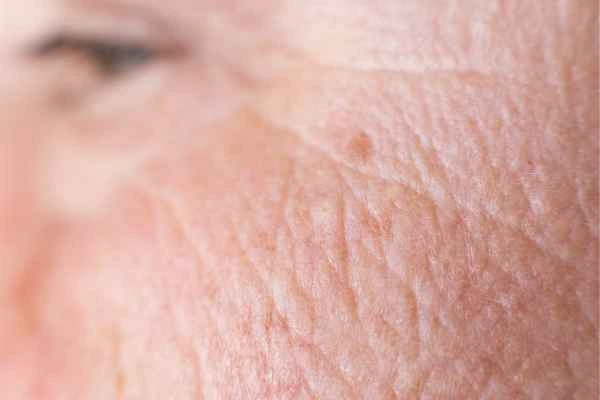 close up picture of a woman's face showing an age spot Wentworth