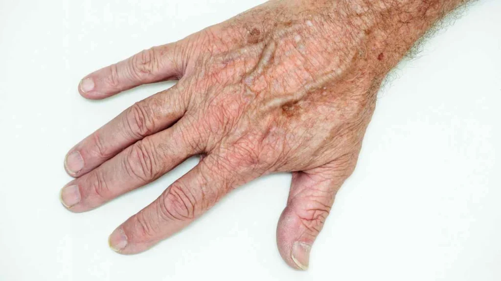 Male hand showing age spot Wentworth