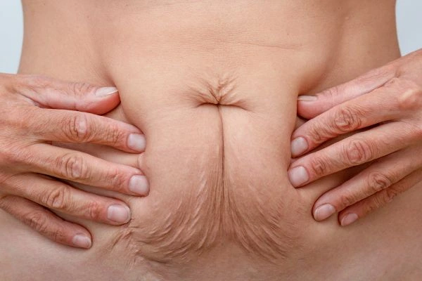 Image of a woman's stomach with loose skin - example of skin tightening Wentworth options