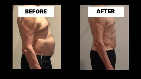 What Symptoms Can Diastasis Recti Cause in Men? Weak Core, Back Pain and Poor Posture Wentworth